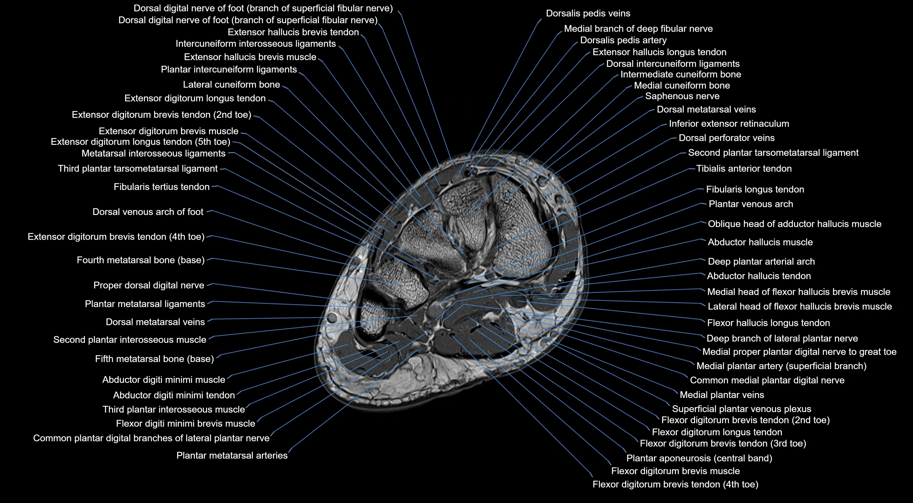 MRI mid foot coronal ligaments cross sectional anatomy 3T  radiology  image-img-00001-00018.webp